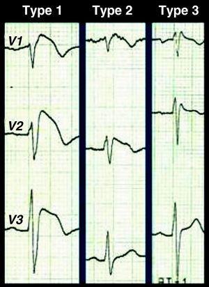 Three repolarization patterns associated with BS.