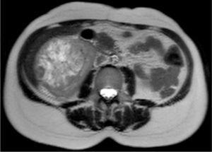 Nuclear magnetic resonance image of renal oncocytoma – transverse view.