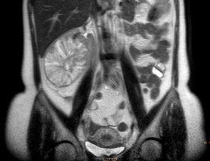 Nuclear magnetic resonance image of renal oncocytoma – coronal view.