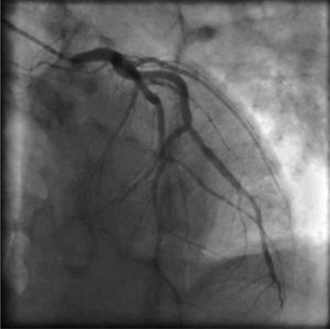 Left coronary angiogram showing no significant obstruction in the left anterior descending coronary artery (left anterior oblique view with cranial angulation).