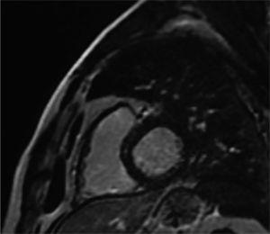 Contrast-enhanced magnetic resonance imaging demonstrating absence of delayed hyperenhancement in the right or left ventricles.