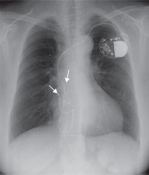 Chest X-ray showing two pacemaker leads fixed on the right atrial appendage, one of them belonging to a previous pacemaker system, sectioned and abandoned in the atrial cavity (arrows).