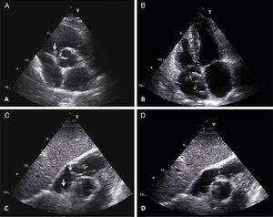 Transthoracic echocardiographic images. A – Parasternal short-axis view showing a mass prolapsing into the right ventricle (large arrow). B – Apical 4-chamber view demonstrating a pacemaker lead in the right atrium (small arrows). C – Modified subcostal view showing two mobile masses adherent to a pacemaker lead (large arrows). D – One of the masses is shown prolapsing into the right ventricle (small arrow).