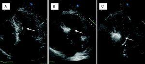 Myocardial contrast echocardiography during alcohol septal ablation. First, the anatomy of the heart is presented and the target septal area is identified (A). Injection of echocardiographic contrast into the target septal branch opacifies the basal part of the septum, verifying the optimal choice of septal branch (B). A more sustained opacification of the basal septum after alcohol injection signifies a good alcohol depot (C).