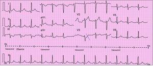 Admission ECG showing sinus rhythm with ST-segment elevation in DI and aVL and ST-segment depression in DIII and aVF.