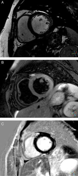 CMRI: (A) T1-weighted sequence showing no significant abnormalities; (B) hyperintense myocardial signal in T2-weighted turbo spin-echo sequences located in the lateral wall; (C) late gadolinium enhancement in the subepicardium of the same wall.