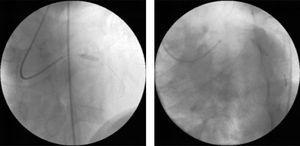 Intervención coronaria percutánea con stent directo de las lesiones observadas en la angiografía diagnóstica: Stent DRIVER de 3mm×12mm en la arteria descendente anterior proximal (izquierda) y stent DRIVER de 3mm×15mm en la arteria circunfleja media (derecha).