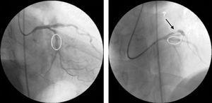 Control coronary angiography following stenting of the proximal left anterior descending artery and mid circumflex artery, showing a good angiographic result at the intervention sites, and a new lesion in the proximal circumflex.