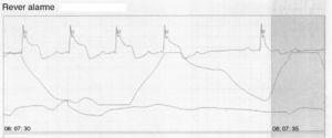 ECG trace showing angina associated with transient ST-segment elevation during continuous monitoring.