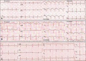 Serial electrocardiograms in a patient with takotsubo cardiomyopathy mimicking anterior myocardial infarction. (A) Acute phase: sinus tachycardia and ST-segment elevation in V2–V6; (B) subacute phase (2nd day): T-wave inversion in I, II, III, aVF, and V3–V6; (C) subacute phase (5th day): beginning of normalization and reduction in T-wave amplitude.