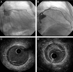Intravascular ultrasound images of the anterior descending artery in a patient transplanted five years previously, showing both the concentric intimal thickening typical of cardiac allograft vasculopathy (C) and an eccentric plaque typical of atherosclerotic coronary disease (D). Coronary angiography did not suggest disease in this artery (A and B).