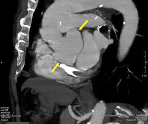 Computed tomography showing severe dilatation of the aortic root (arrow).