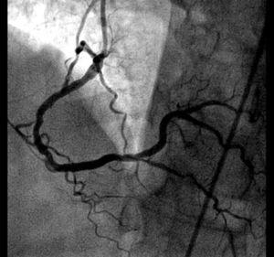 Posterior descending artery with 70% stenosis.