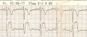 ECG with Brugada pattern during a respiratory infection.