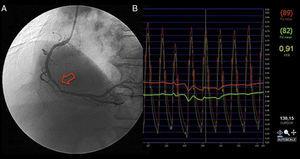Intermediate lesion of the mid right coronary artery assessed by fractional flow reserve (A); FFR=0.91 during maximal hyperemia (B), leading to deferred intervention.