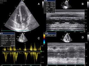 Transthoracic echocardiography after onset of shock, showing biventricular dysfunction and mild circumferential pericardial effusion. (A) Apical 4-chamber view showing mild hypertrophy of the left ventricular walls (probably edema); (B) M-mode assessing ventricular dimensions and left ventricular function; (C) left ventricular outflow tract velocity-time integral, an indirect measure of left ventricular function; (D) right ventricular function assessed by tricuspid annular plane systolic excursion. LVOT: left ventricular outflow tract; TAPSE: tricuspid annular plane systolic excursion; VTI: velocity-time integral.