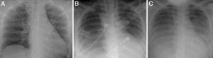 Chest X-rays. (A) Image from original hospital; (B) Image 48 hours after admission to the cardiothoracic intensive care unit showing right pleural effusion; (C) image at the time of transfer back to original hospital, showing persistent right pleural effusion despite clinical improvement.