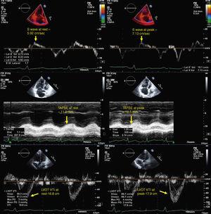 Echocardiographic parameters of right ventricular contractile reserve in a pulmonary hypertension patient at rest (left) and at peak exercise (right); top – S-wave velocity; middle – <span class=
