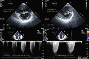 Echocardiographic measurements in a pulmonary hypertension patient at rest (left) and at peak exercise (right); top – diastolic left ventricular eccentricity index; bottom – RV/RA gradient. D1 and D2: left ventricular diameters; LV exc index: diastolic left ventricular eccentricity index; RV/RA grad: right ventricular/right atrial gradient in systole.