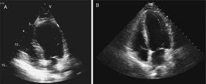 Transthoracic echocardiogram in 4-chamber apical view (systolic frames) on admission revealing akinesia of the mid-apical segments and aneurysmatic dilatation (A) and echocardiographic reassessment (B), on the sixth day of hospitalization, showing recovery of left ventricular systolic function, with no segmental wall motion abnormalities.