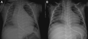 (A) Chest X-ray at admission showing cardiomegaly (cardiothoracic ratio 80%); (B) chest X-ray on day 25, showing reversal of cardiomegaly with treatment (cardiothoracic ratio 52%).