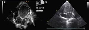 Two-dimensional left apical 4-chamber echocardiographic views: (A) enlarged left ventricle on admission; (B) after 25 days of treatment, left ventricular diameters are completely normal.
