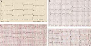 Electrocardiographic changes in the patient throughout life. (A) PR interval 0.11 s; LVH/ST‐T pattern (1997, age 44 years); (B) marked LVH and ST‐T abnormalities (2007, age 54 years); (C) atrial fibrillation (2010, age 57 years); (D) recent ECG (2012, age 59 years).
