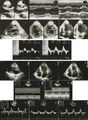 Transthoracic echocardiogram/Doppler imaging. Top (1998, age 45 years): long‐axis view showing mild septal thickening, non‐dilated and normally contracting left ventricle, and normal left atrium (A, B, C); short‐axis view at the level of the mitral leaflet tips (D) and mid‐cavity (E); apical 4‐chamber view showing slight thickening of the lateral‐apical wall (F); middle (2007, age 54 years) – normal tissue Doppler imaging at the septal (G) and lateral (H) corners of the mitral annulus; bottom (2012, age 59‐years) – thickened septum (I, J, M – 20 mm); thickened lateral‐apical wall (J); non‐dilated and normally contracting left ventricle (M); dilated left atrium, 51 mm (L); mild mitral regurgitation (K); diastolic dysfunction and affected longitudinal systolic LV function (N, O, P – see text for details).