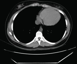 Axial non‐enhanced chest computed tomography showing displacement of the heart with the apex in left posterior position. Parietal pericardium cannot be observed between epicardial and mediastinal fat.