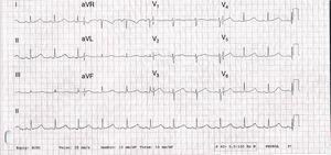 12-lead electrocardiogram showing sinus rhythm and significant QTc prolongation (565 ms).