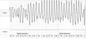Polymorphic ventricular tachycardia detected on implantable event recorder.