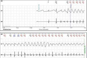Intracardiac electrogram from implantable cardioverter-defibrillator showing polymorphic ventricular tachycardia detected by remote monitoring.
