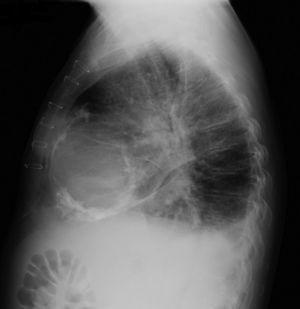 Chest X-ray, left lateral view, showing calcification of the cardiac silhouette.