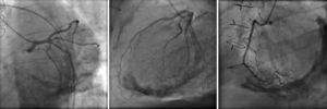 Coronary angiography showing no coronary artery disease and marked calcification of the cardiac silhouette.