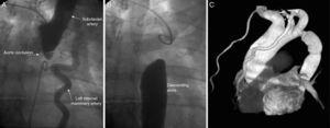 Angiography: (A) from right radial artery; (B) from femoral artery. Complete aortic coarctation of 16–11mm in axial and longitudinal diameter; (C) tube graft interposed between the ascending and descending thoracic aorta.