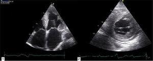 Transthoracic echocardiogram showing non-dilated left ventricle with severe hypertrophy of the septum and moderate hypertrophy of the other walls, non-dilated right ventricle, and severe biatrial dilatation (A); small circumferential pericardial effusion (B).