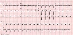 atrial flutter vs afib