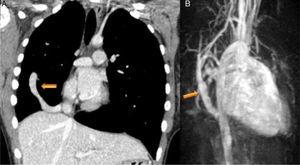 (A) Coronal-reformatted contrast-enhanced computed tomography showing the scimitar vein draining into the inferior vena cava (arrow) as well as right pulmonary hypoplasia with left lung expansion; (B) sagittal four-dimensional magnetic resonance imaging angiographic image also demonstrating the scimitar vein (orange arrow).