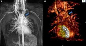 (A) Three-dimensional and (B) four-dimensional magnetic resonance angiographic images showing the anomalous left superior pulmonary vein (arrow) draining into the brachiocephalic vein (BV). Ao: aorta; JV: jugular vein; SVC: superior vena cava.
