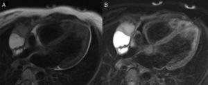 Cardiac magnetic resonance imaging with double inversion recovery (A) and double inversion recovery with fat saturation (B), showing areas of hyperintensity and hyposignal suggesting possible liquid, fat or bloody/high-protein components inside the compartments of the complex pericardial cyst.