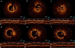(a) Right coronary artery (RCA) dissection visible by optical coherence tomography (OCT); (b) and (c) intrastent thrombosis in RCA visible by OCT; (d-f) intrastent view of the RCA by OCT after thrombus aspiration.