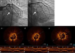 (a) Stent thrombosis in the first marginal; (b) first marginal after thrombus aspiration and stent placement; (c-e) thrombus in the first marginal documented by optical coherence tomography.