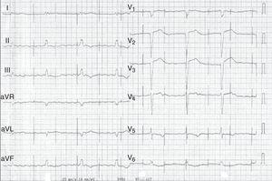 Electrocardiogram after syncope showing atrial flutter with signs of pacemaker malfunction (undersensing and loss of ventricular capture).