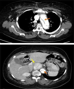 Thoracic-abdominal-pelvic computed tomography showing aortic dissection (orange arrow) and an echodense mass compatible with a paraganglioma (yellow arrow).