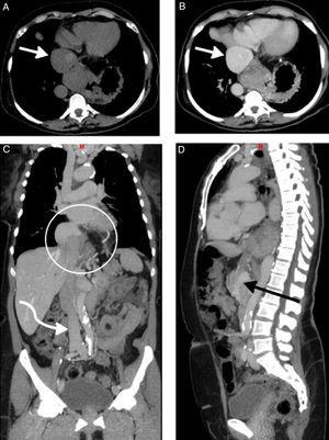 Computed tomography angiography of the chest, abdomen and pelvis, without contrast (A) and with contrast in the venous phase (B-D), showing aneurysmal dilatation of the proximal inferior vena cava next to its opening into the right atrium, reaching 56 mm in its largest diameter (A and B, straight white arrow). The middle, right and left hepatic veins drained into the aneurysmatic area, which was herniated into the thoracic region with part of the hepatic segment (C, white circle). Distal to the aneurysm, in the intrahepatic portion, the IVC was practically collapsed, with a very small caliber, for about 35 mm (D, black arrow). In the subhepatic region, into which the other abdominal and pelvic veins drained, the IVC had a normal appearance and caliber (C, curved white arrow).