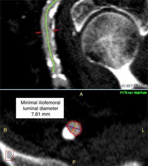 Assessment of minimal iliofemoral luminal diameter from MDCT imaging.