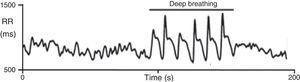 Heart rate response to deep breathing. A normal response showing the imprint of respiration in the heart rate recording during deep breathing. Adapted from Ducla-Soares et al.73