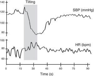Normal heart rate and blood pressure responses to head-up tilt testing. In this test the subject lies on a tilt test table, which is then tilted upward at 60°-70° after a resting period of at least 5 min. Patients with different degrees of cardiovascular autonomic impairment may show delayed adaptation to the orthostatic challenge or may even be unable to adapt and have a syncopal event. HR: heart rate; SBP: systolic blood pressure. Adapted from Ducla-Soares et al.73