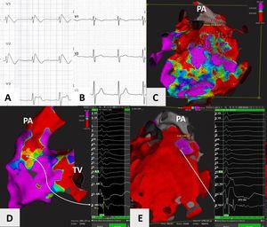 (A and B) Precordial leads (V1 to V3) showing presence of spontaneous type 1 Brugada pattern at the start of the procedure, and its disappearance nine months later; (C) epicardial voltage map of the right ventricle using the Rhythmia™ mapping system, anteroposterior view with 0.5 and 1.5mV as voltage cut-off points, showing large areas of fibrosis in the right ventricular outflow tract (RVOT) and anterior wall of the right ventricle; (D) endocardial voltage map of the right ventricle, posteroanterior view, showing an area of fibrosis in the posteroseptal aspect of the RVOT. A long (>120ms), complex, small-amplitude and fractionated potential is highlighted; (E) potential duration map of the epicardial aspect of the right ventricle, anteroposterior view, showing area of potentials lasting more than 291ms (purple), corresponding to the ablated zone. Areas of potentials lasting less than 200ms are in red. Highlighted is a very long and complex potential measuring approximately 371ms. PA: pulmonary artery; TV; tricuspid valve.