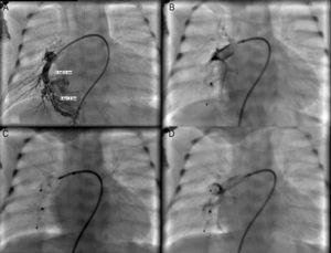 (A) Selective angiography of the right pulmonary artery showing a large pulmonary arteriovenous malformation with two afferent vessels; (B) successful closure of the 3.1 mm feeding artery with a 4 mm Amplatzer® Duct Occluder II and of the 6 mm feeding artery with a 7 mm Amplatzer® Vascular Plug (C and D).